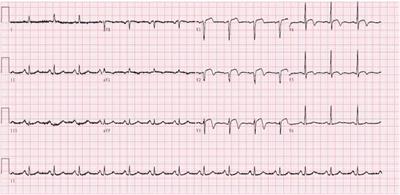 Case Report: A case of Kounis syndrome induced by iodine contrast agent during coronary angiography